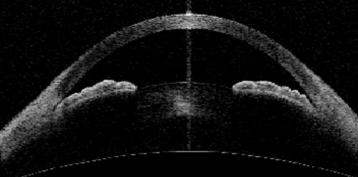 Angle-Closure Glaucoma OCT