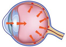 Ocular Hypertension OHT Eye pressure