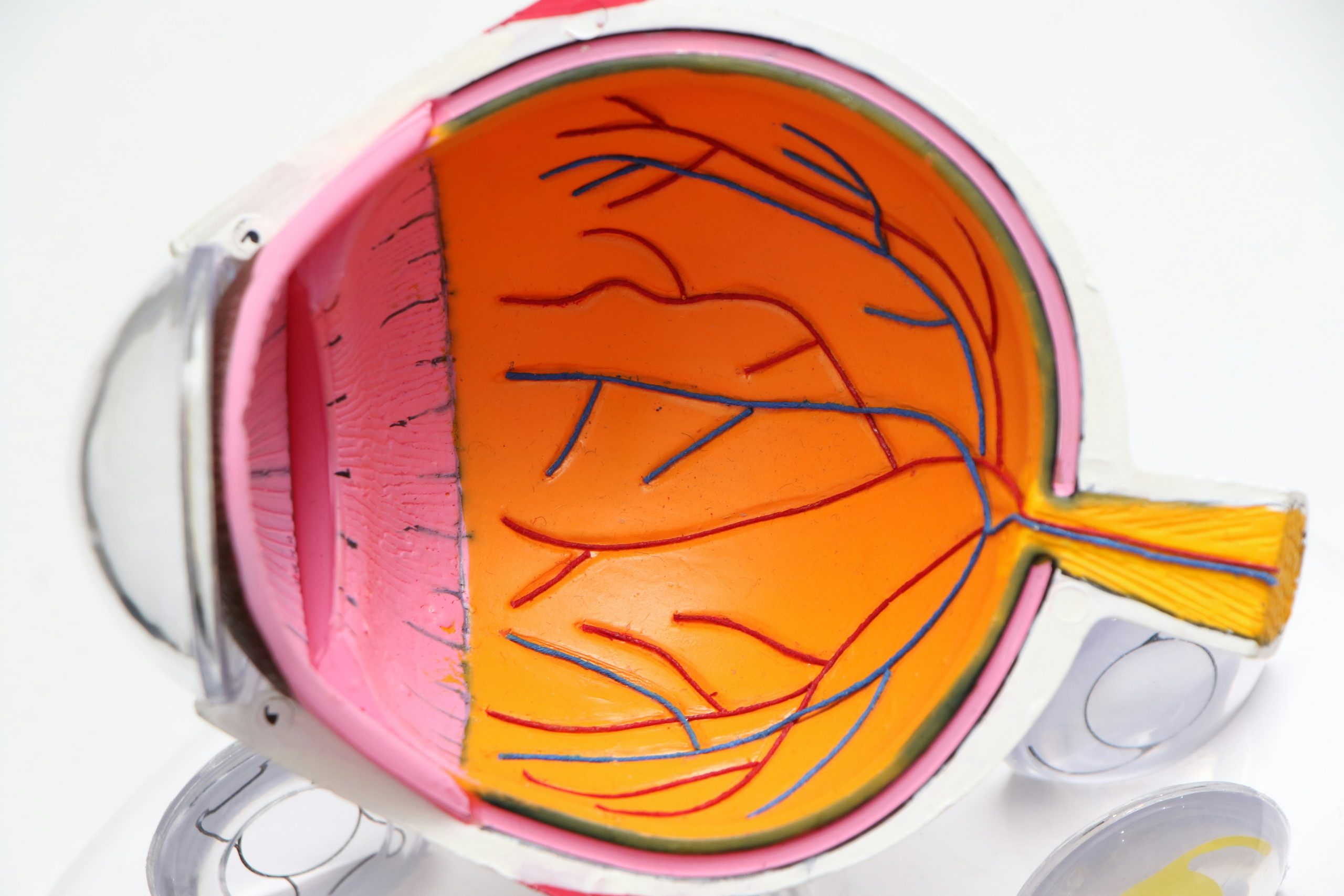 Eye structure with optical nerve in Glaucoma