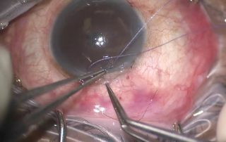 Trabeculectomy