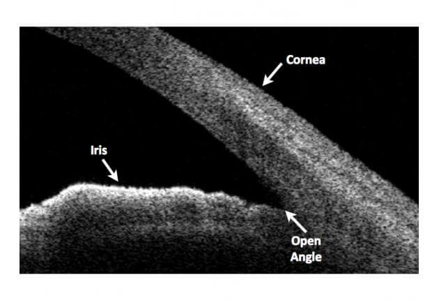 Primary Open-Angle Glaucoma OCT