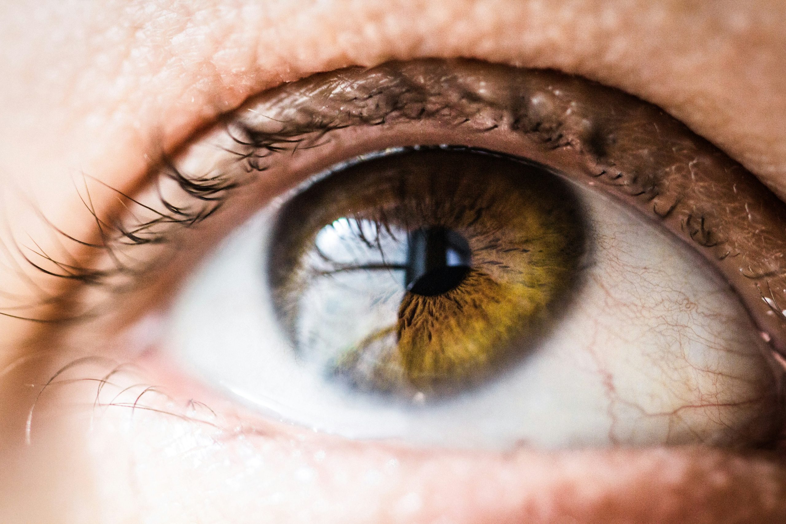 Ocular Hypertension: Understanding Elevated Eye Pressure